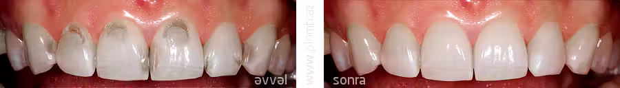 dişlərin plomblanması əvvəl sonra